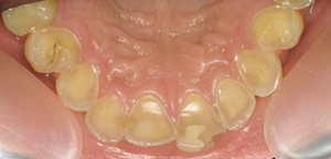 Dental Erosion from Acid Reflux