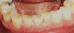 Damage to dnamel and dentine from dental erosion