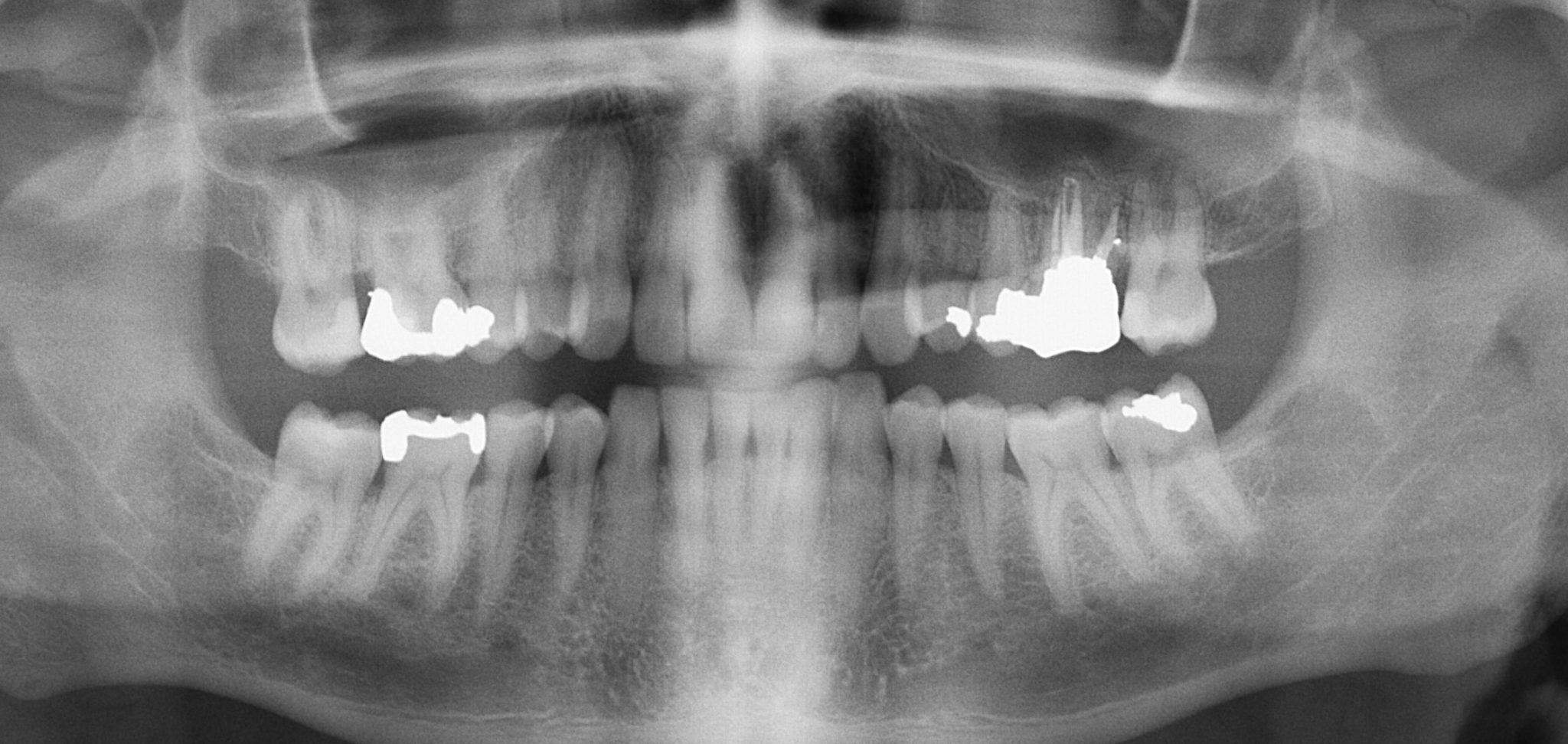 Abnormal Panoramic Dental X Ray